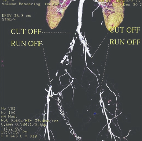 Arterial Cut-Off and Run-Off in Comparison with Surgical Findings {faces}